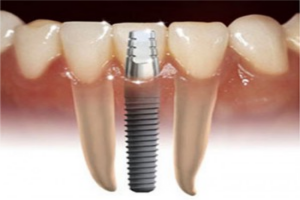 Bagaimana Hukum Implant Gigi?