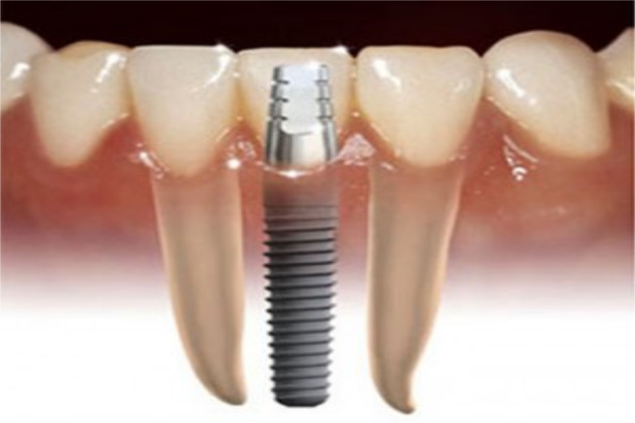 Bagaimana Hukum Implant Gigi?